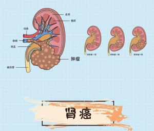阿昔替尼在治疗进展期肾细胞癌中疗效怎样？
