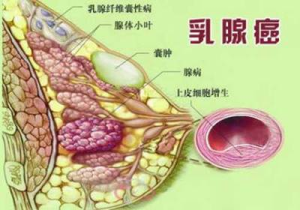 阿培利司为什么对乳腺癌PIK3CA突变患者更有效？